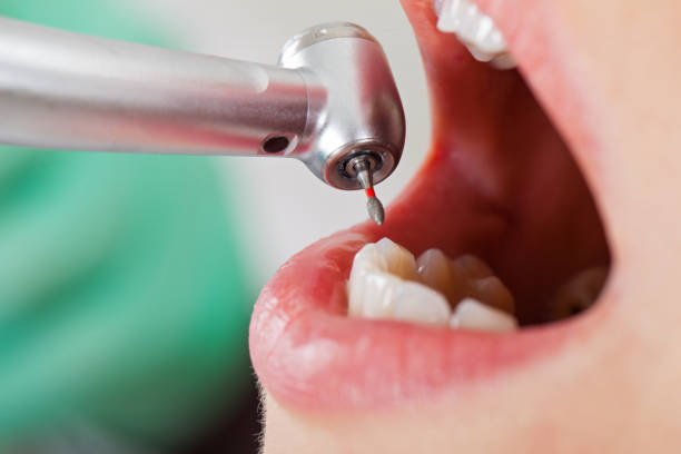 Best Dental Abscess Treatment in Russellville, KY